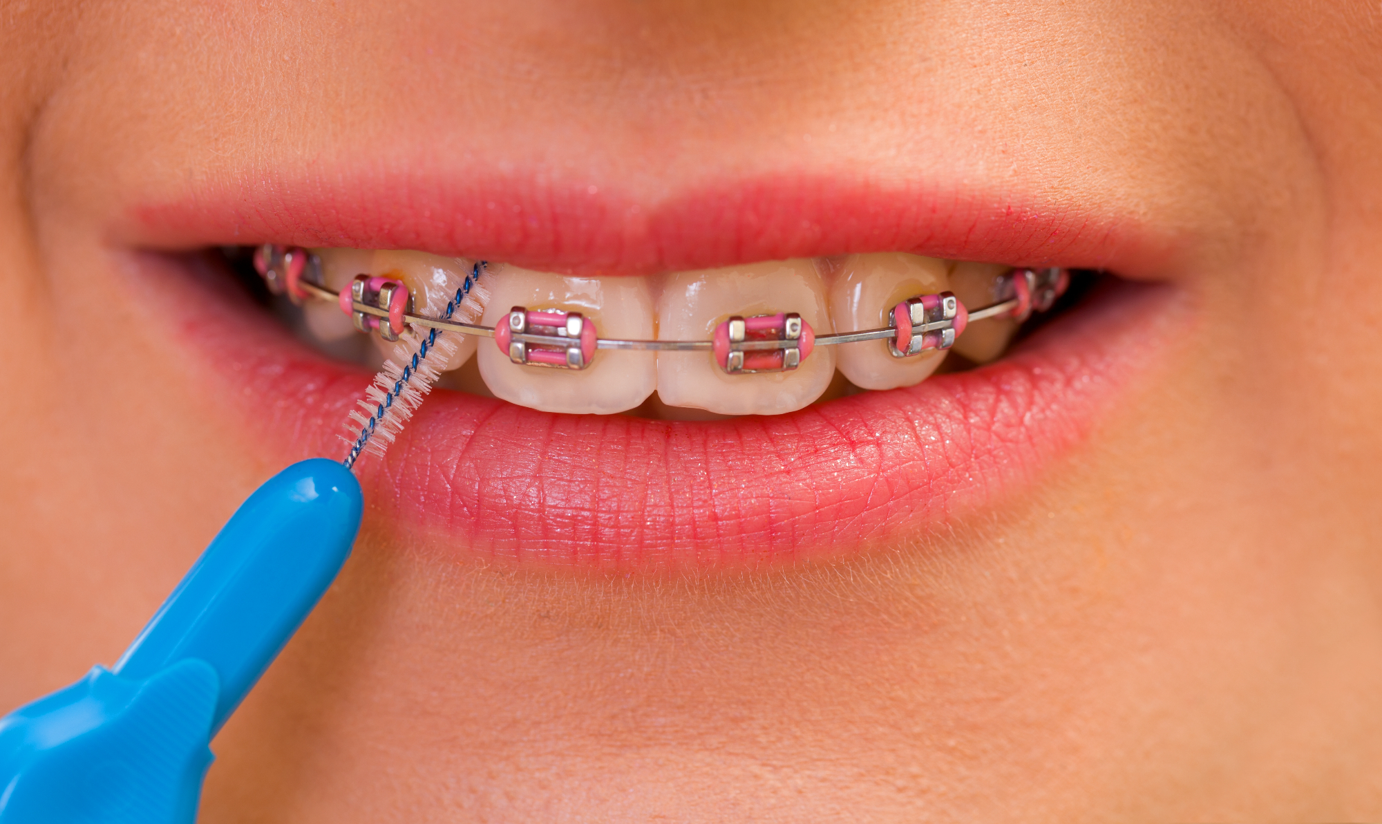 Ortodont Ljubljana vam pomaga tudi pri izbiri primernega aparata za zobe